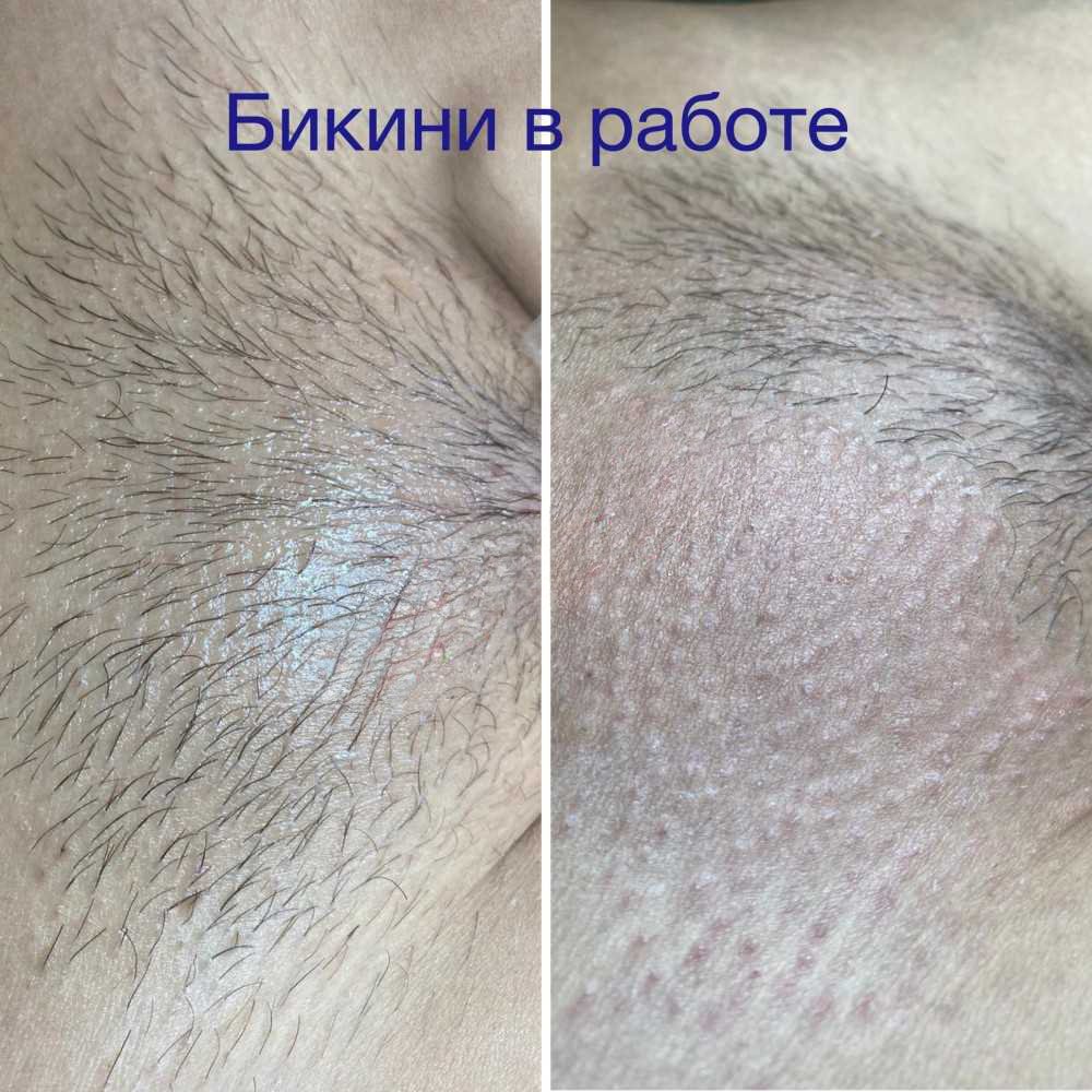 Безболезненная эпиляция Ташкент