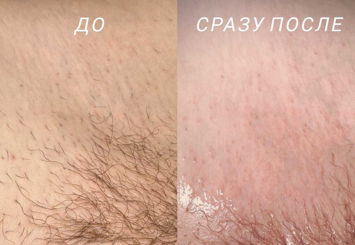 Электроэпиляция цена бикини Ташкент